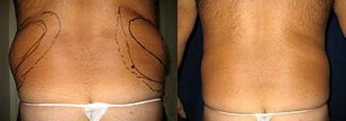 liposukceboky muzepred
