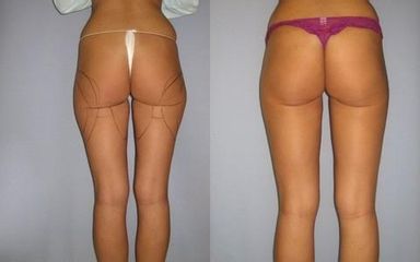 laserlipo1