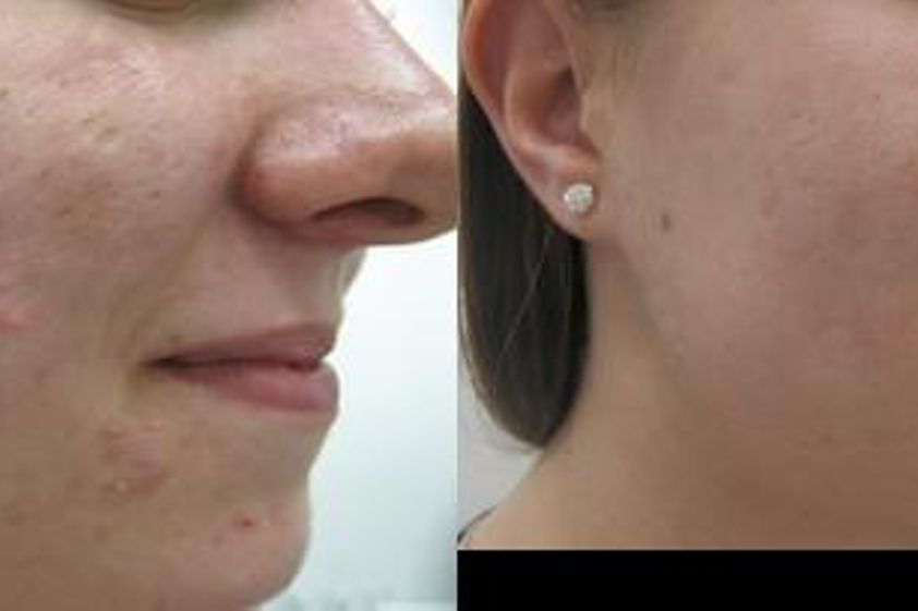 Biostimulační laser před a po - 720500