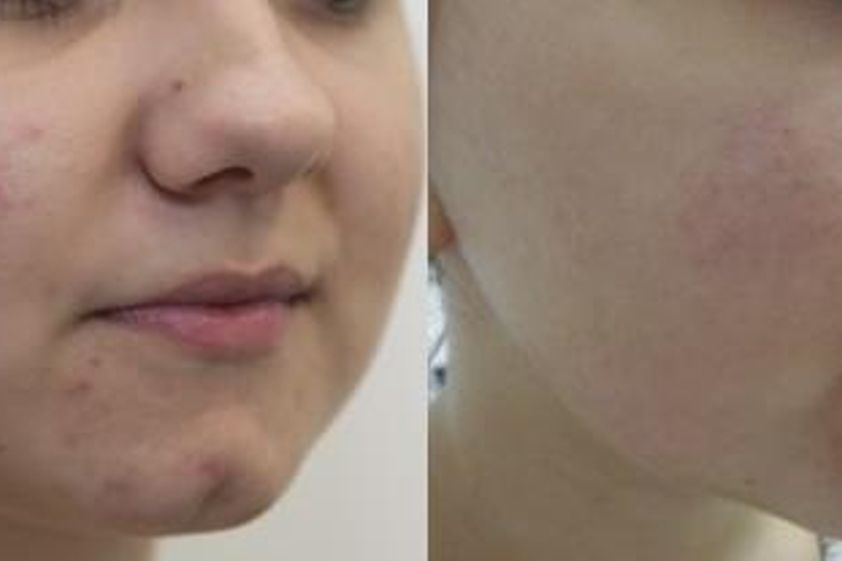 Biostimulační laser před a po - 720526