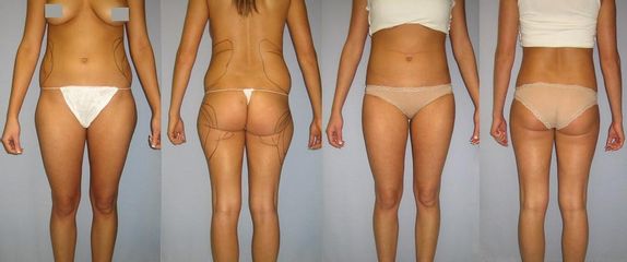 Laserová liposukce MPX