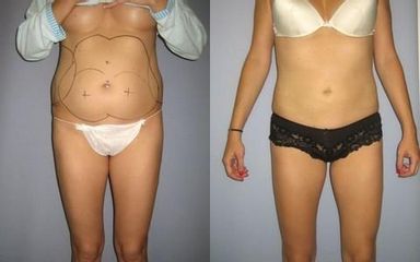 laserlipo5