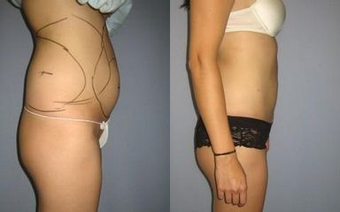 laserlipo9
