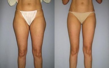 laserlipo13