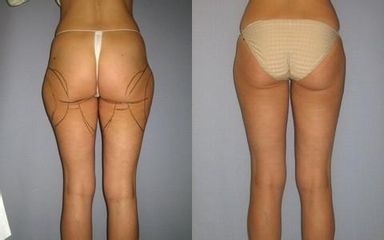 laserlipo15