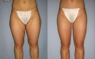 laserlipo17