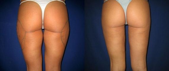 laserlipo29