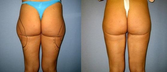 laserlipo31