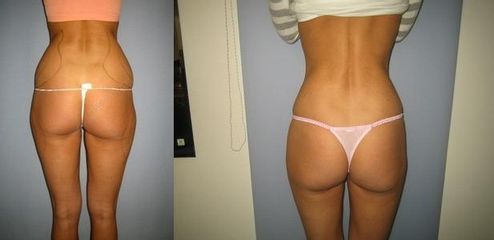 laserlipo35