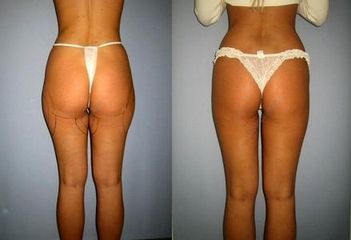 laserlipo37