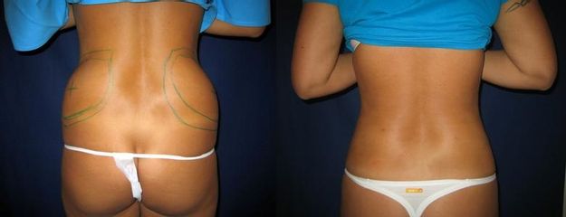 laserlipo41