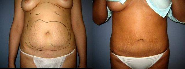 laserlipo47