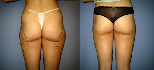laserlipo51
