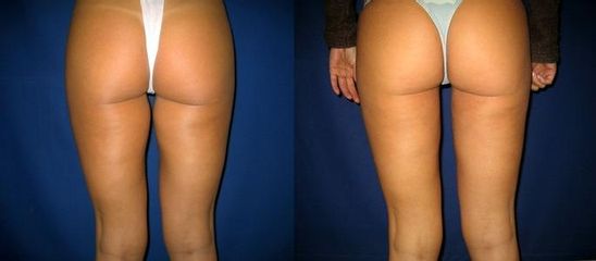 laserlipo53
