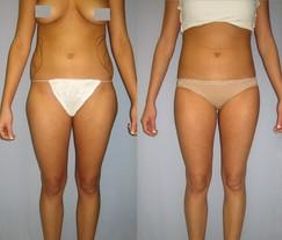 laserlipo55