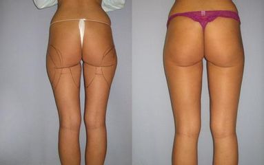 las.liposukce 1před
