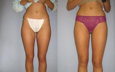 las.liposukce 2před