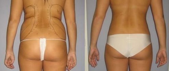 laserlipo57