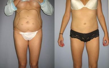 las.liposukce 3před