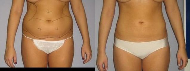 laserlipo59