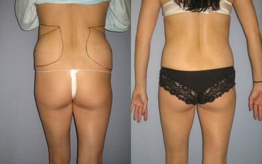 las.liposukce 4před