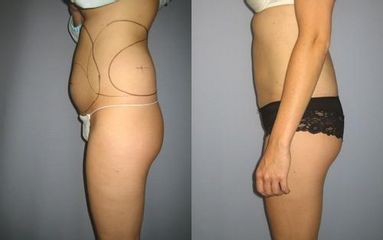 las.liposukce 6před
