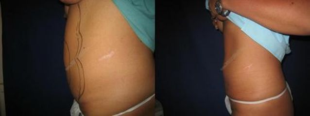 las.liposukce 9před