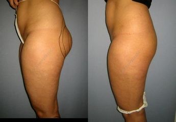las.liposukce 15před