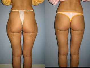 las.liposukce 17před