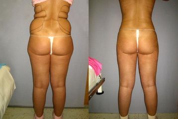 liposukce