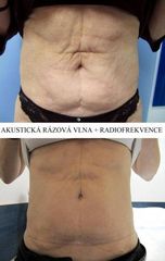 Akustická rázová vlna a Radiofrekvence