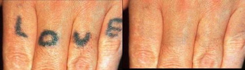 tetovani pred 143 x 250