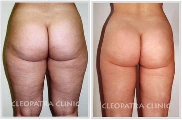 liposukce stehen-zevní a vnitřní a kolen