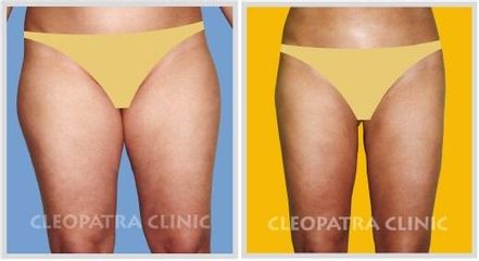 liposukce stehen-zevní a vnitřní a kolen