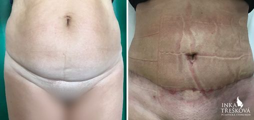 Abdominoplastika - Prim. MUDr. Inka Třešková Ph.D.