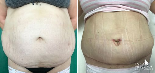 Abdominoplastika - Prim. MUDr. Inka Třešková Ph.D.
