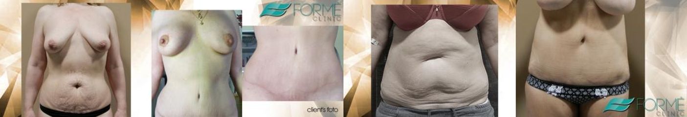 abdominiplastika modelace augmentace logo