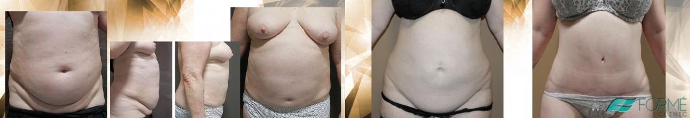 abdominoplastika