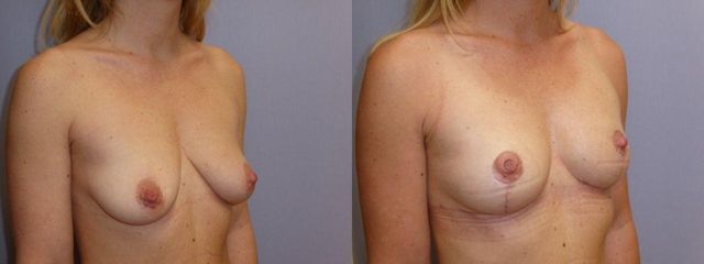 Modelace prsou