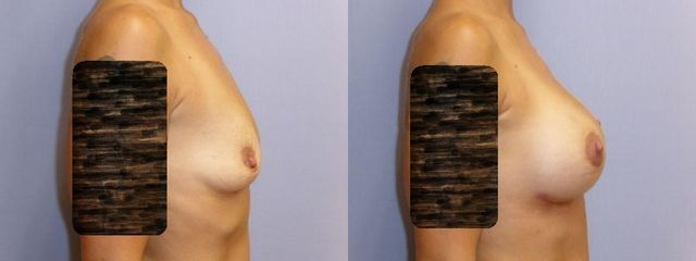 zvětšení prsou (Augmentace)