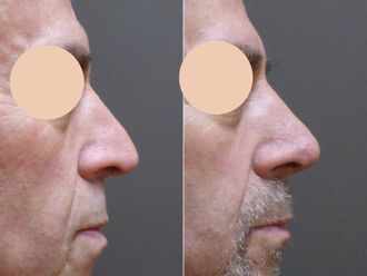 Rhinoplastika před a po - 877012