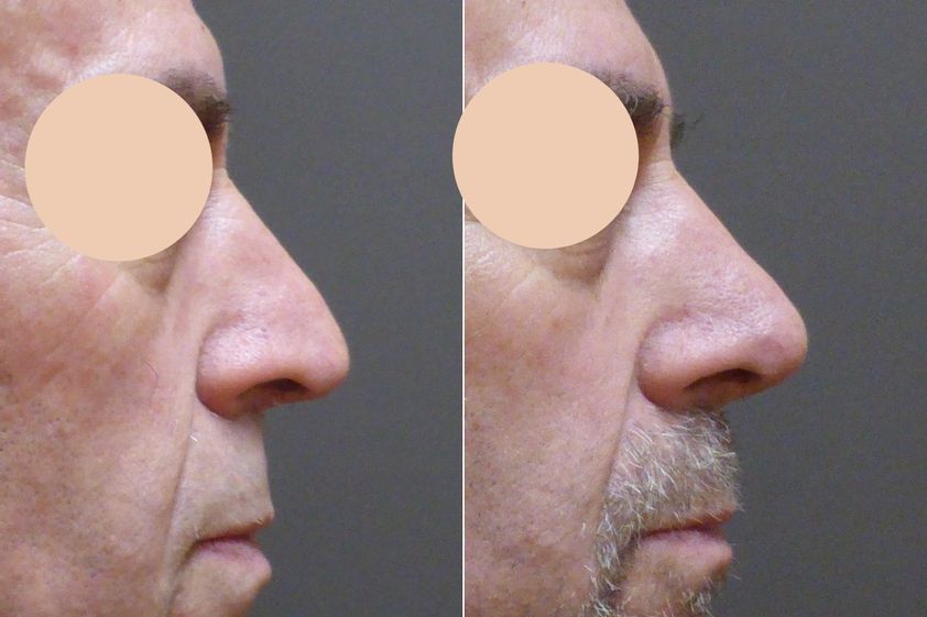 Rhinoplastika před a po - 877012