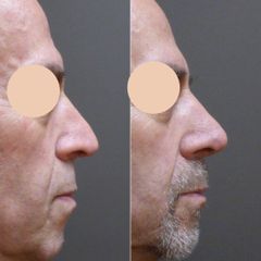 před a 2 týdny po operaci