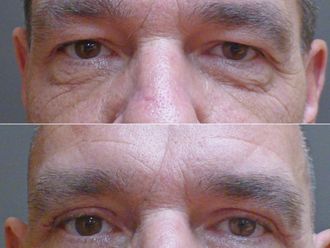 Operace horních víček před a po - 877133