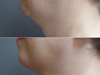 Odstranění podbradku před a po - 877407