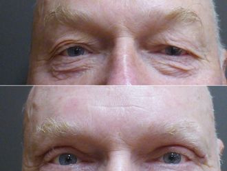 Operace horních víček před a po - 877799