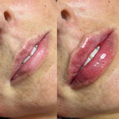 Zvětšení rtů kyselinou hyaluronovou - MyEsthetics
