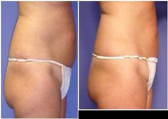 UltraShape