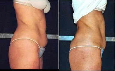 UltraShape