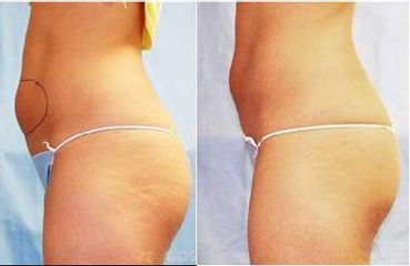 UltraShape